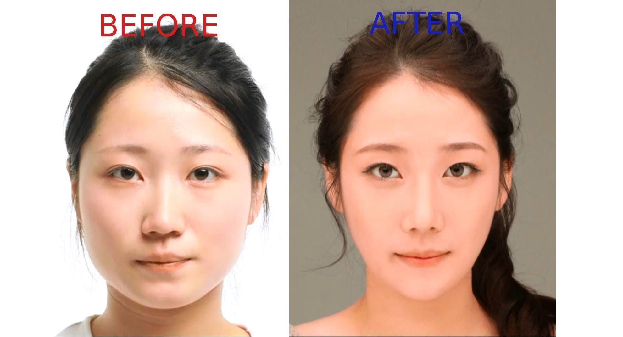 What are the typical costs for different types of plastic surgery?